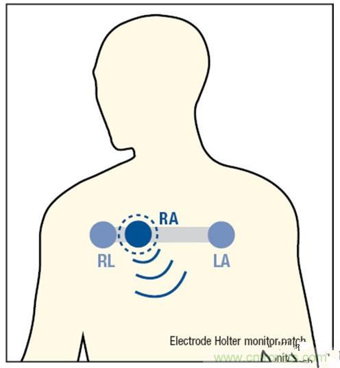 解析:一款可穿戴無線ECG動(dòng)態(tài)心電監(jiān)護(hù)儀的設(shè)計(jì)